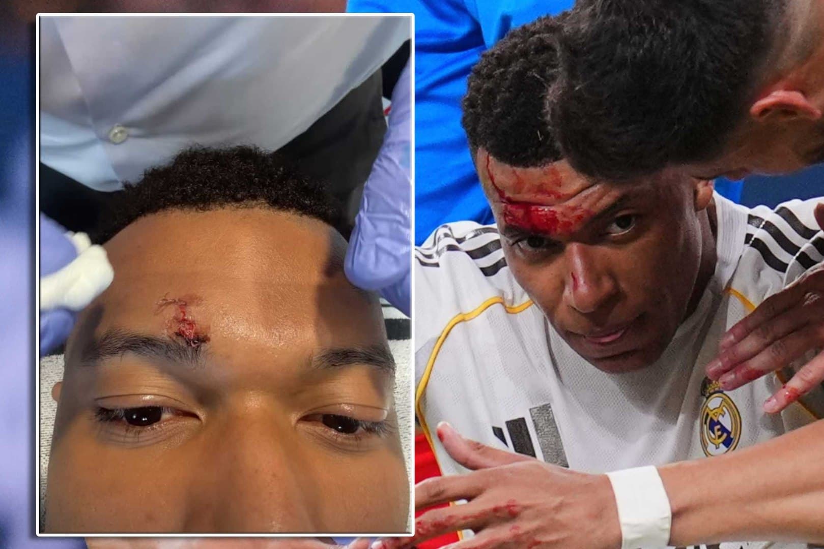 El francés, al que dieron puntos en la ceja derecha concluido el partido frente al Girona, no entrenó por molestias y precaución. "Los tres puntos de la vergüenza", dicen desde Valdebebas.