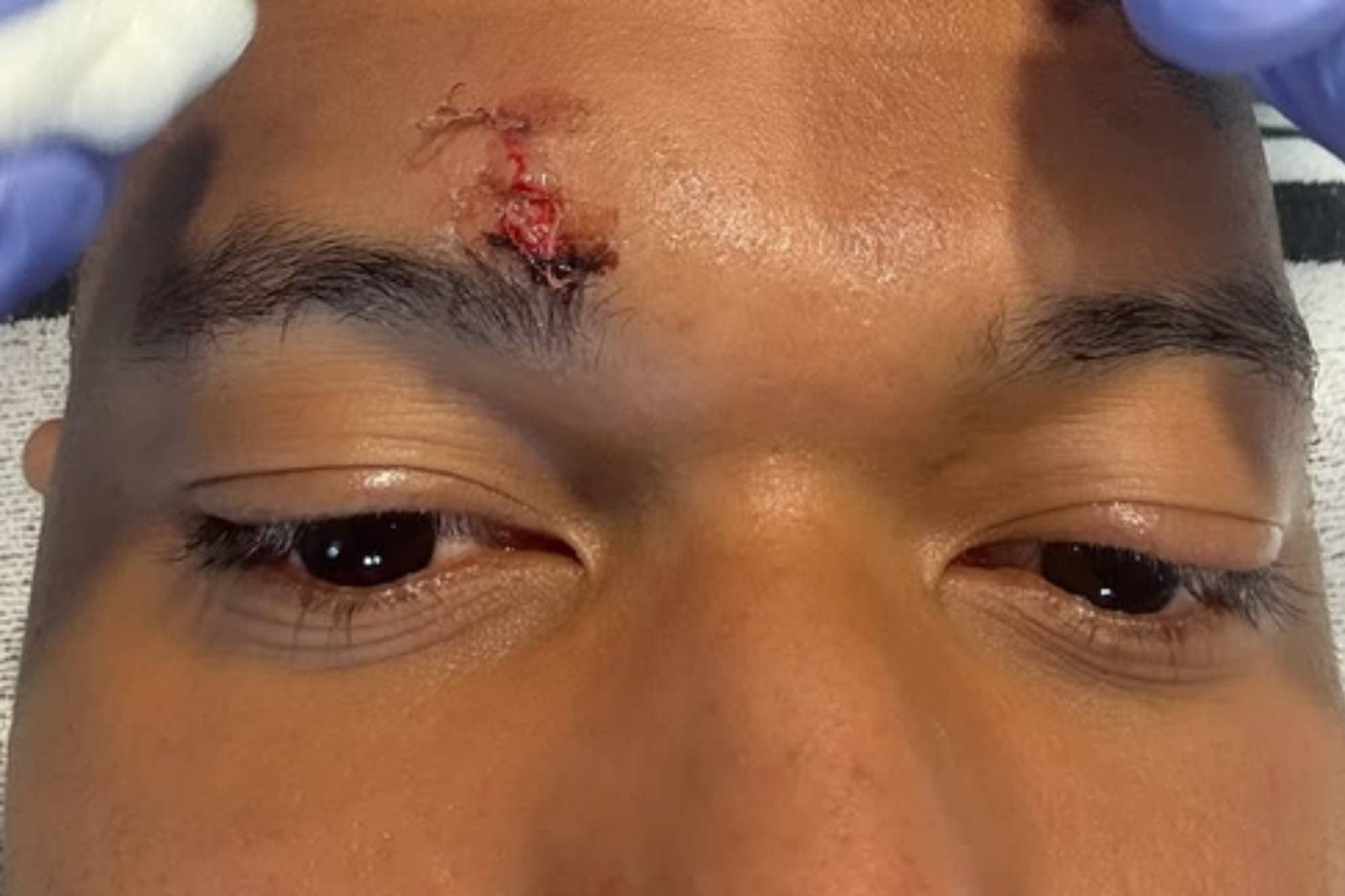 Mbappé sufrió un corte en el ceja contra el Girona y necesitó tres puntos de sutura