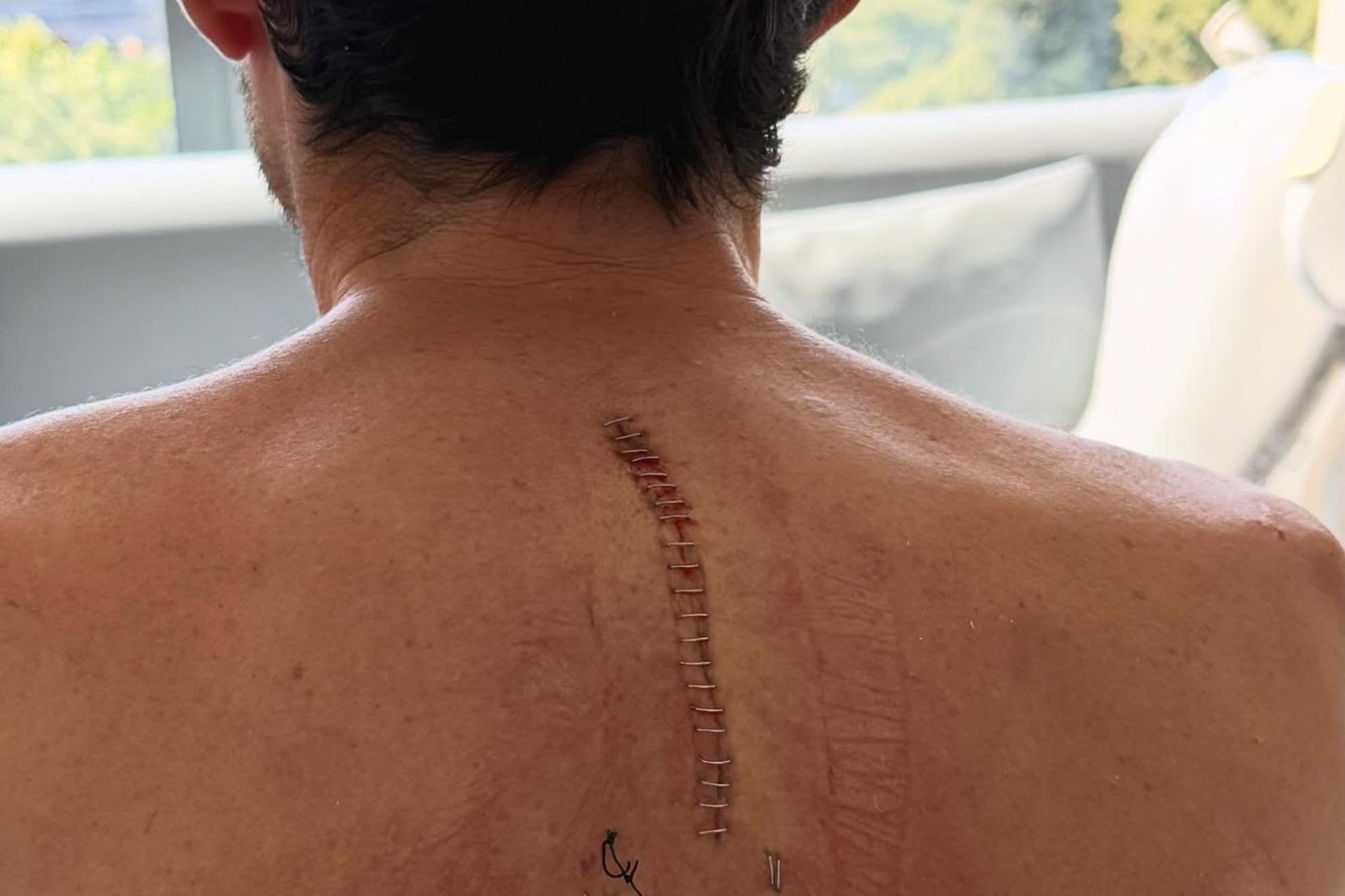 La imagen de la columna vertebral de Aleix, con la cicatriz visible.