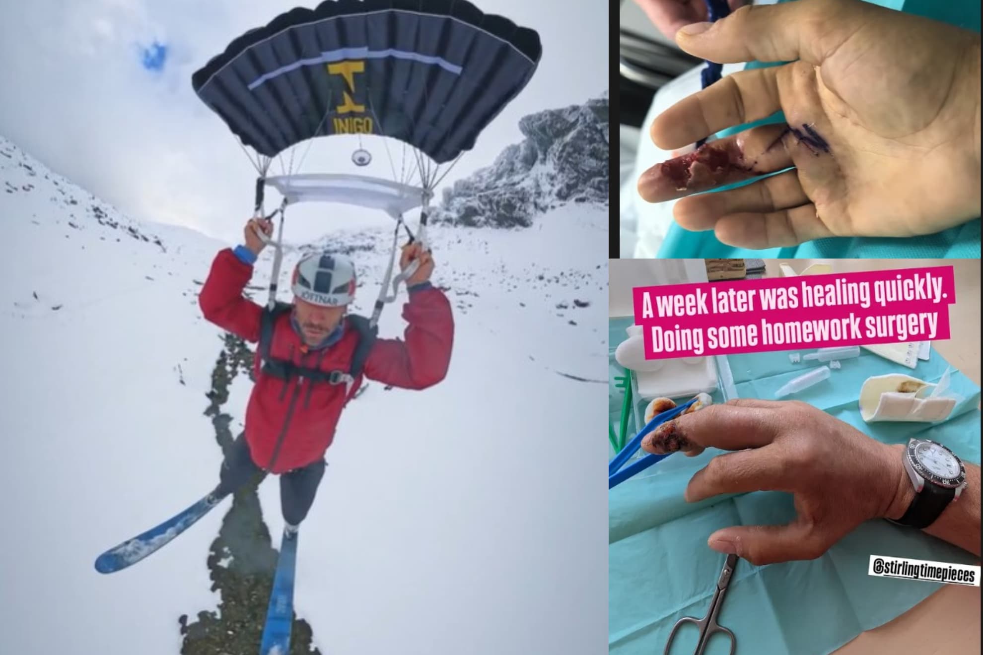 Tim Howell, en un salto con esquíes y como quedó su dedo antes y después de la operación.