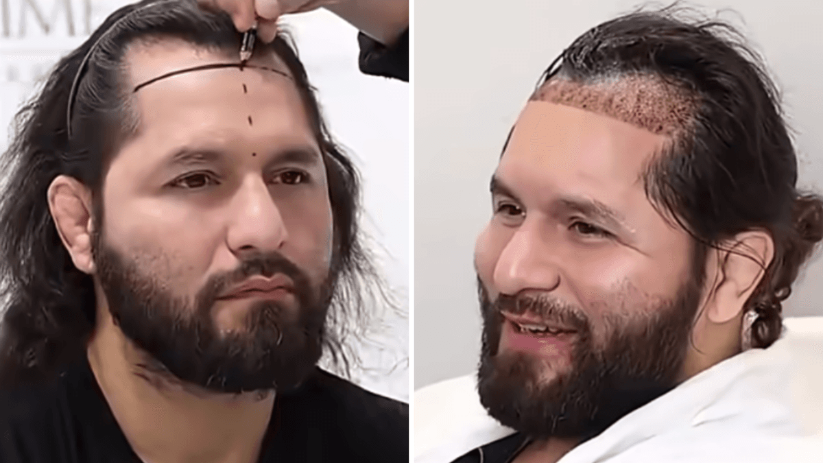 Jorge Masvidal undergoes hair transplant surgery
