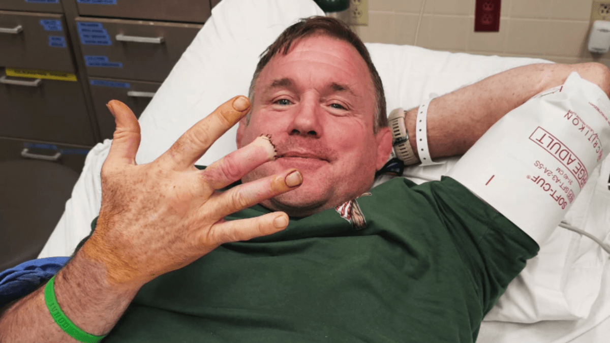 Matt Hughes forced to amputate finger following gory accident