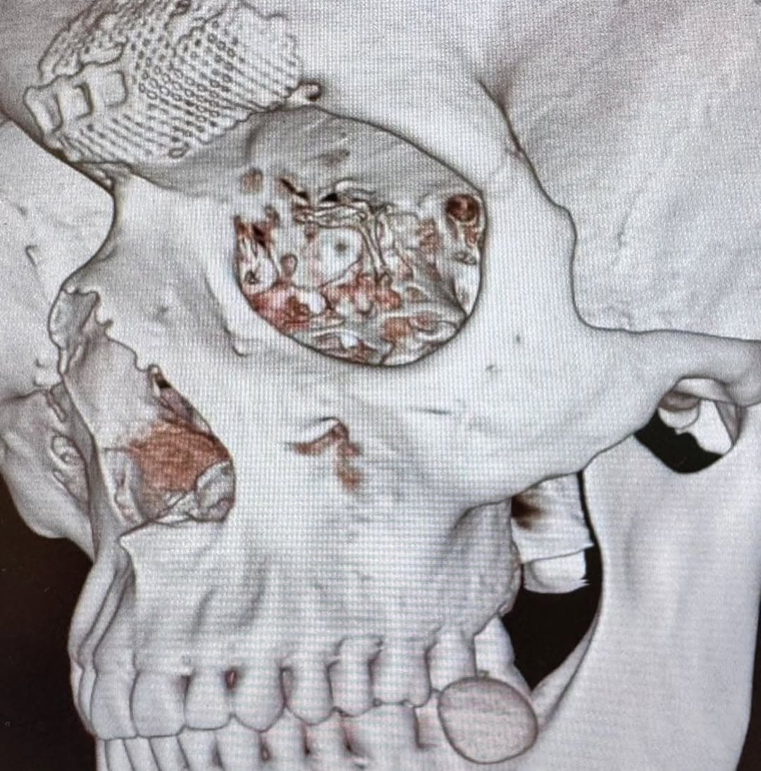 Marco Tulio: No fear ahead of UFC 328 despite surgeries to reconstruct forehead bone after knockout loss