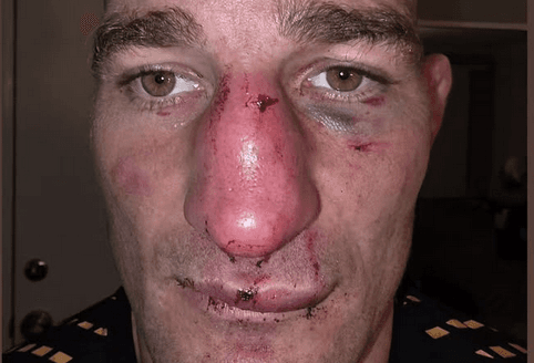 Pic: Sean Strickland shows off gruesome broken nose after UFC 328 title win